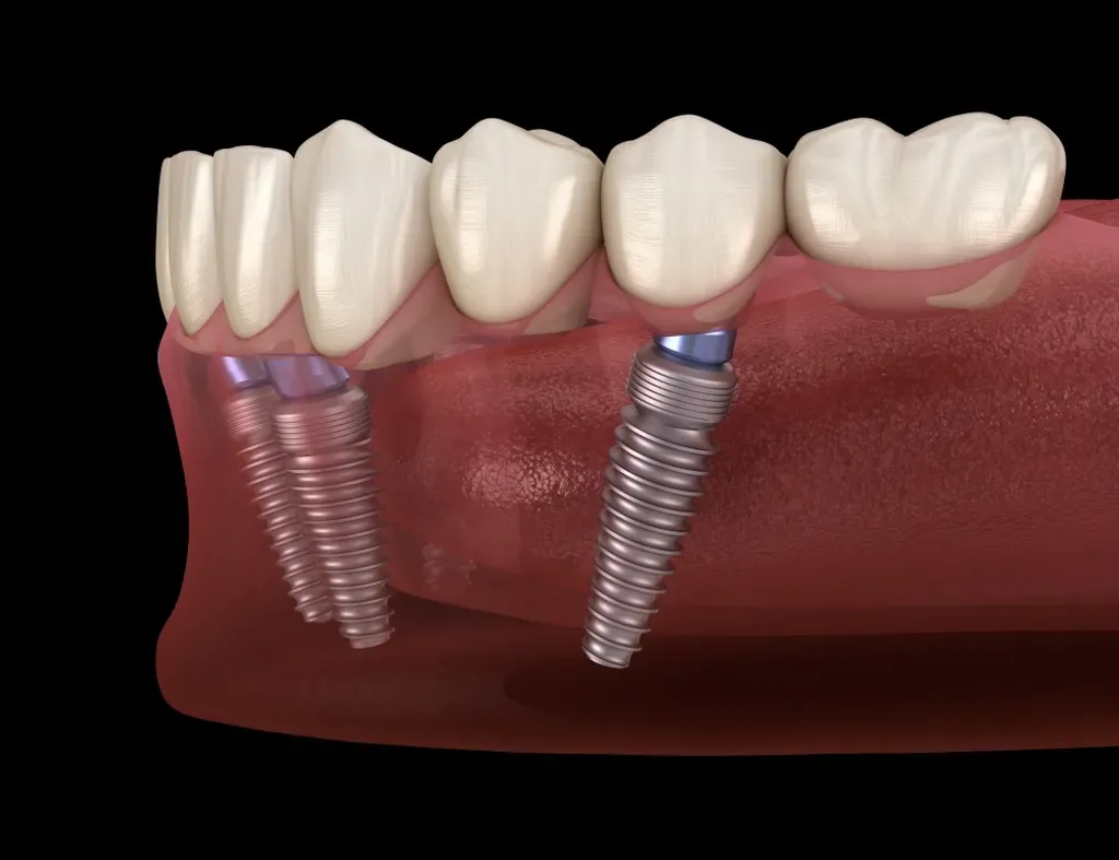 Benefits of All-on-4 Dental Implants