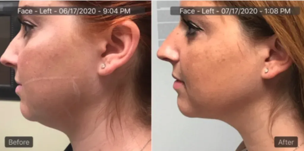 Chisel Your Jawline: A 4-Week Journey to Double Chin Elimination with Agnes RF